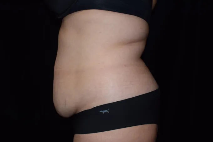 before-after-tummy-tuck-abdominoplasty-1717d