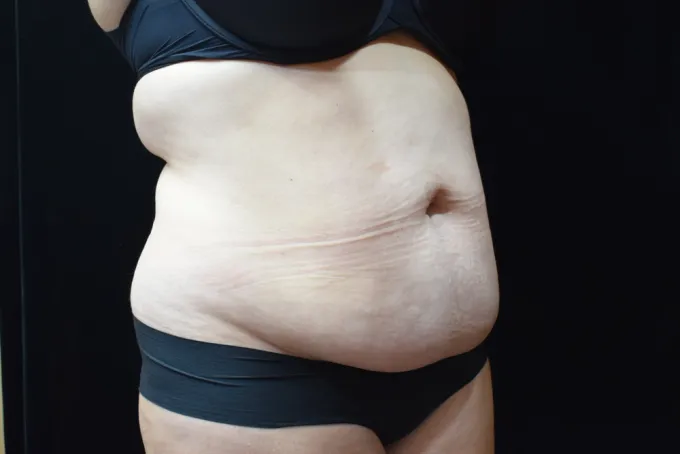 before-after-tummy-tuck-abdominoplasty-1717f