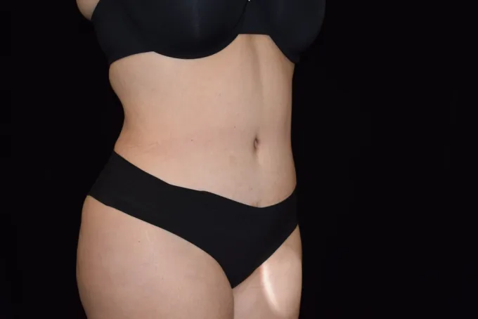 before-after-tummy-tuck-abdominoplasty-1212a