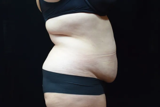 before-after-tummy-tuck-abdominoplasty-1717h