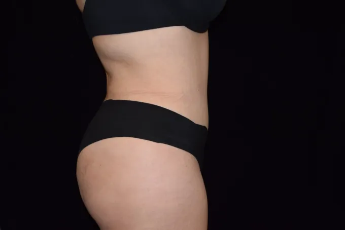 before-after-tummy-tuck-abdominoplasty-1212a