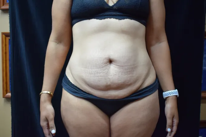 before-after-tummy-tuck-abdominoplasty-1212a