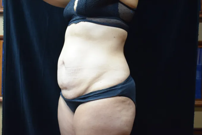 before-after-tummy-tuck-abdominoplasty-1212a