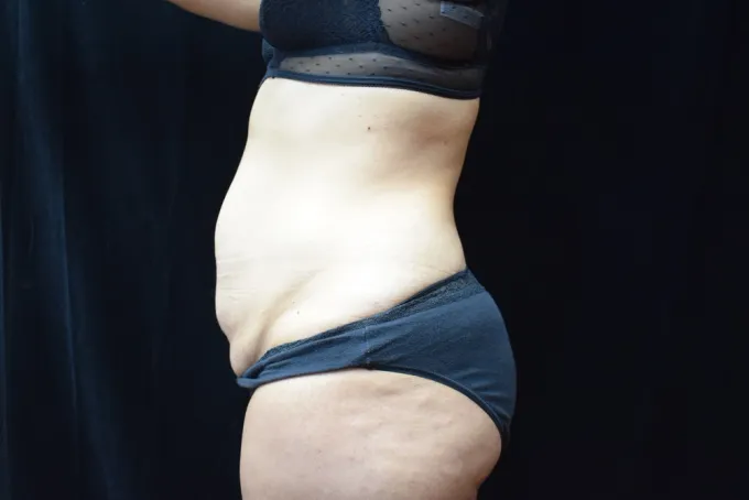 before-after-tummy-tuck-abdominoplasty-1212a