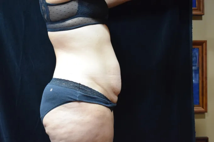 before-after-tummy-tuck-abdominoplasty-1212a