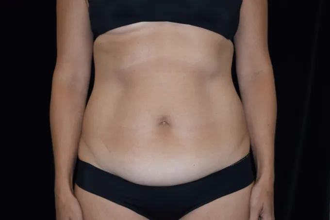before-after-tummy-tuck-abdominoplasty-1212a