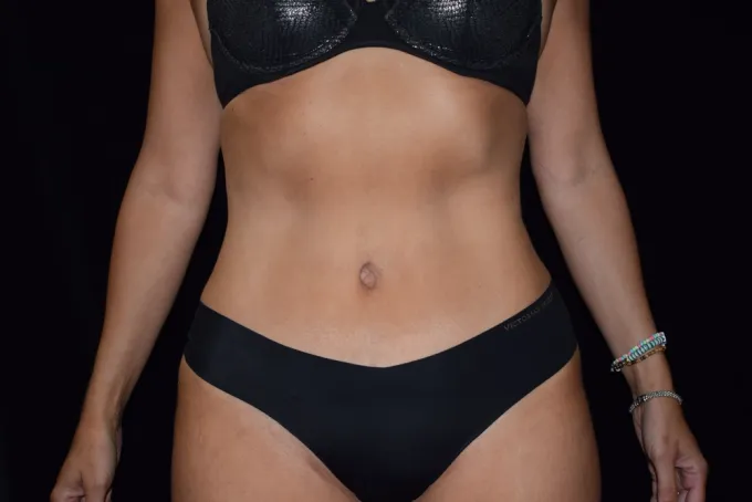 before-after-tummy-tuck-abdominoplasty-1919b