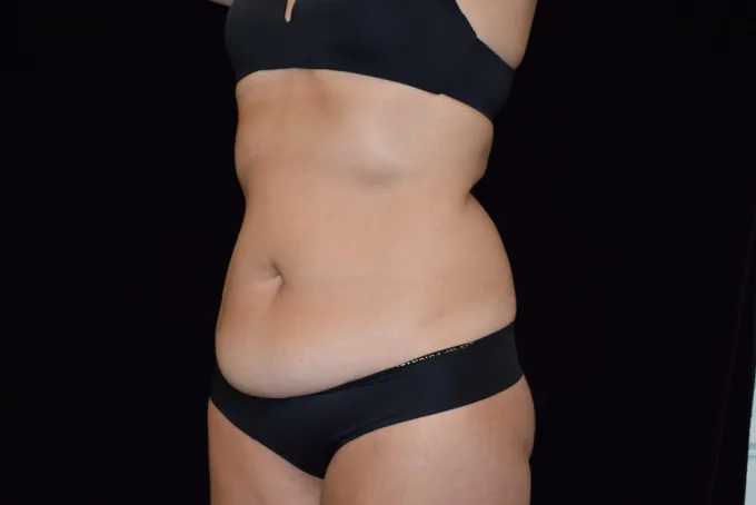 before-after-tummy-tuck-abdominoplasty-1212a