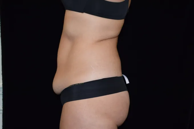 before-after-tummy-tuck-abdominoplasty-1212a