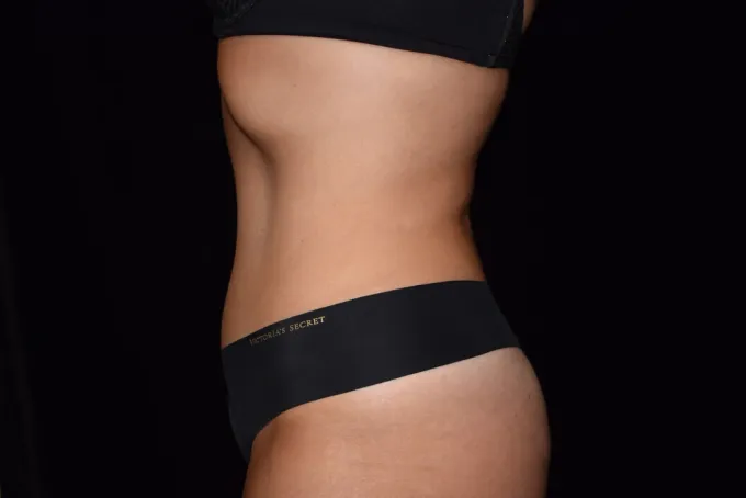before-after-tummy-tuck-abdominoplasty-1919f