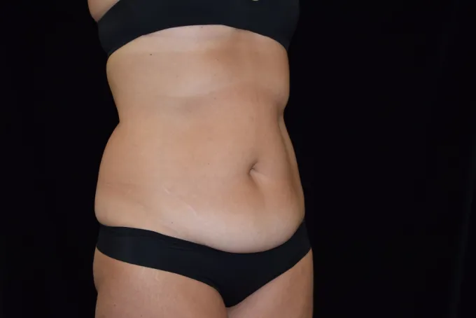 before-after-tummy-tuck-abdominoplasty-1212a