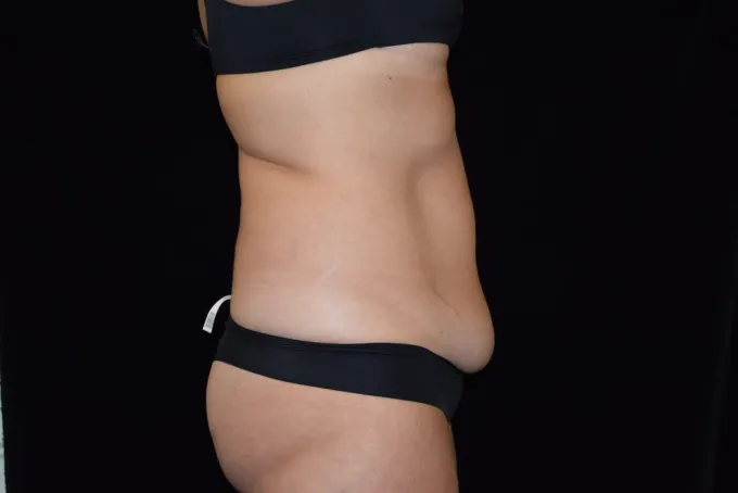 before-after-tummy-tuck-abdominoplasty-1212a