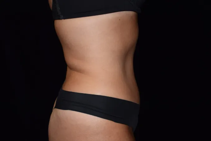 before-after-tummy-tuck-abdominoplasty-1919j