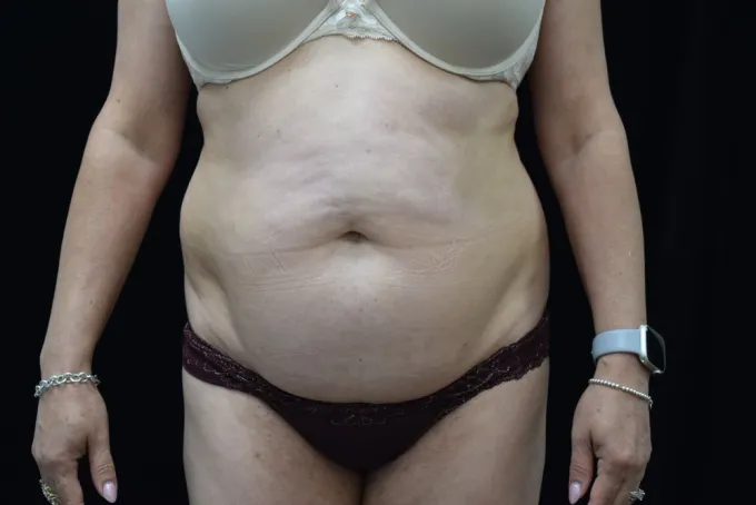 before-after-tummy-tuck-abdominoplasty-1212a