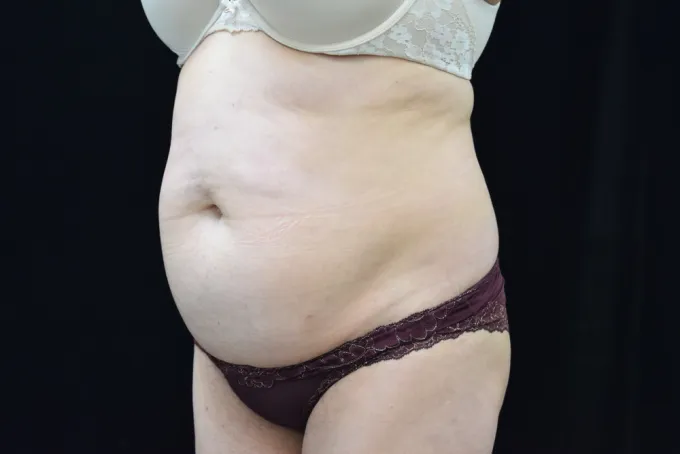 before-after-tummy-tuck-abdominoplasty-1212a