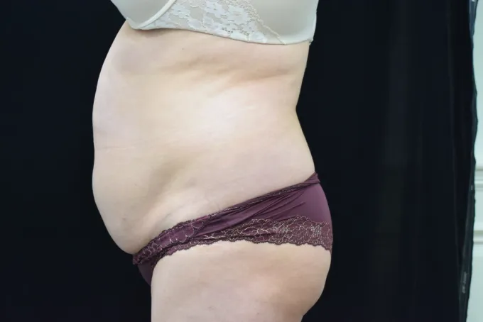 before-after-tummy-tuck-abdominoplasty-1212a