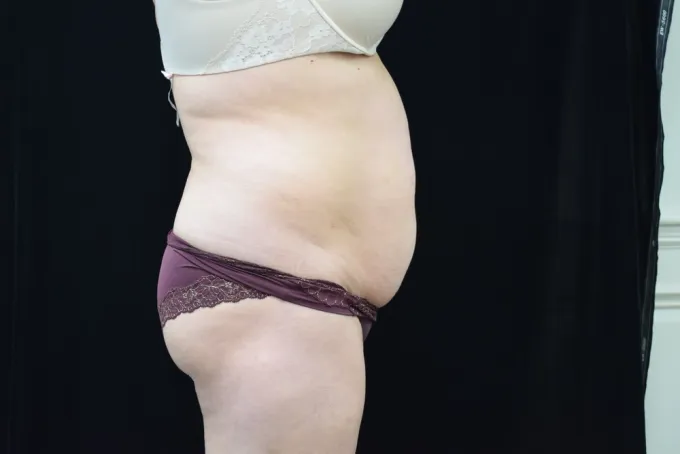 before-after-tummy-tuck-abdominoplasty-1212a
