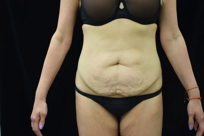 before-after-tummy-tuck-abdominoplasty-1212a