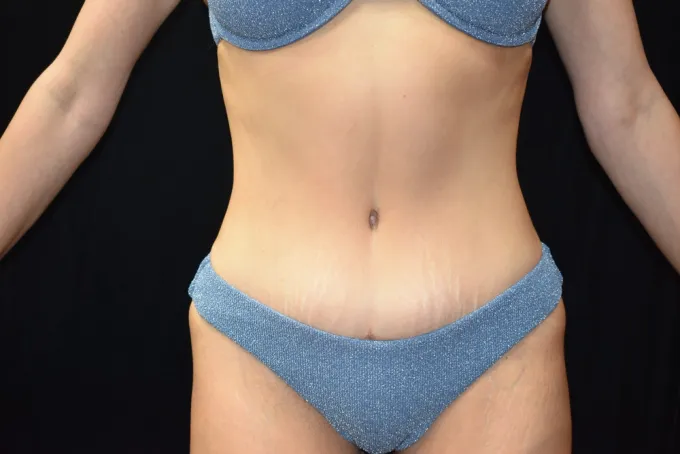 before-after-tummy-tuck-abdominoplasty-2222b