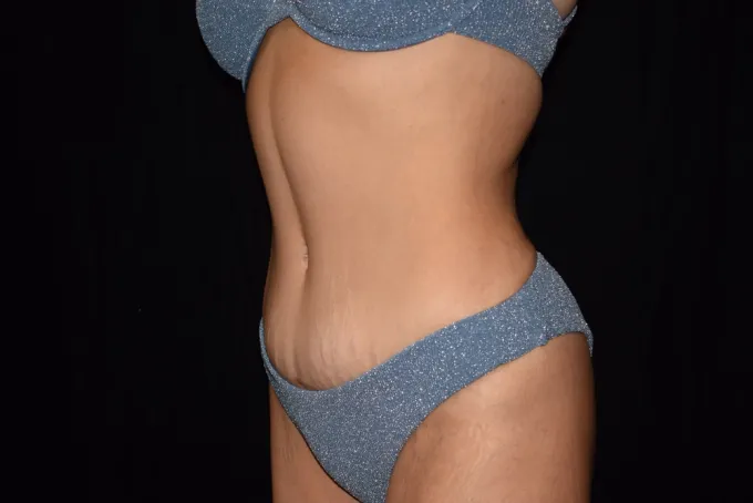 before-after-tummy-tuck-abdominoplasty-2222d