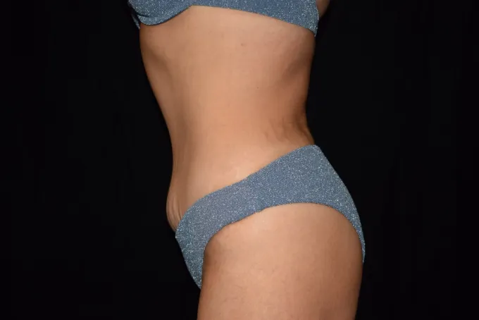 before-after-tummy-tuck-abdominoplasty-2222f