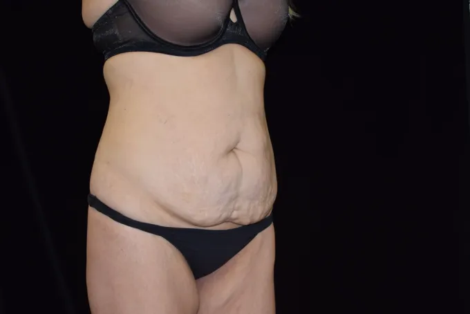 before-after-tummy-tuck-abdominoplasty-1212a