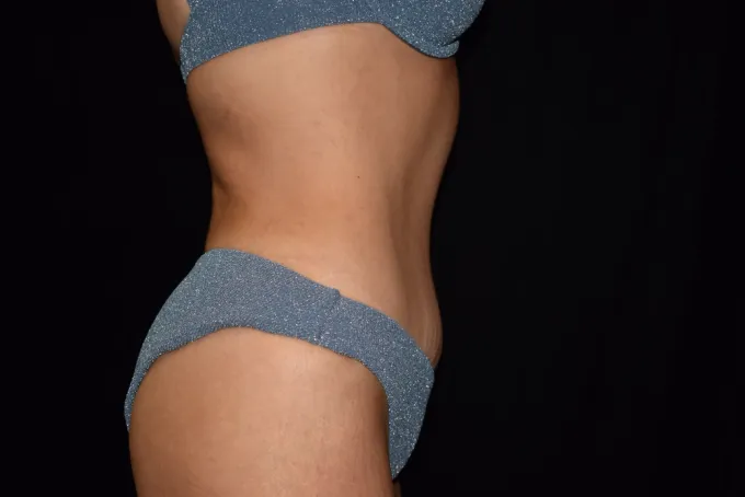 before-after-tummy-tuck-abdominoplasty-2222j