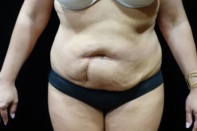 before-after-tummy-tuck-abdominoplasty-1212a