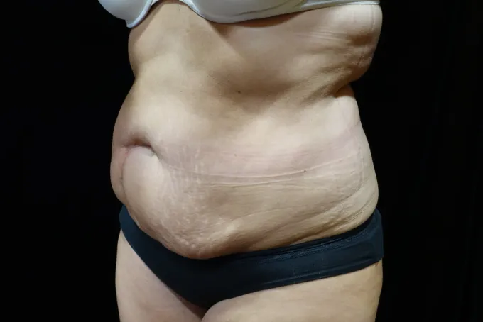 before-after-tummy-tuck-abdominoplasty-1212a