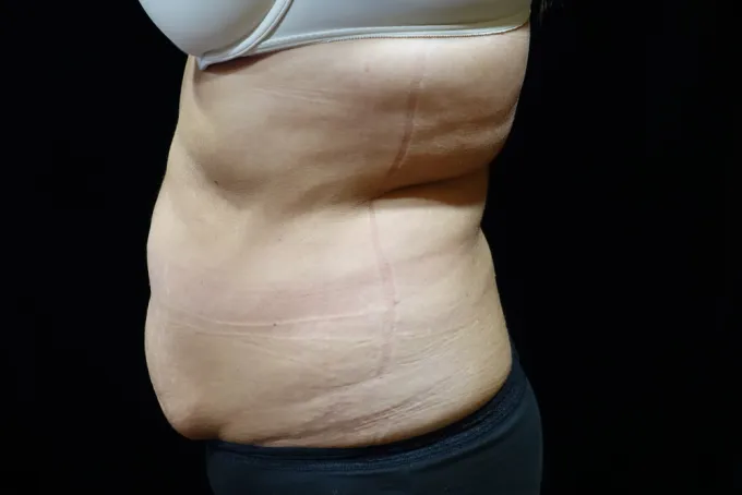 before-after-tummy-tuck-abdominoplasty-1212a