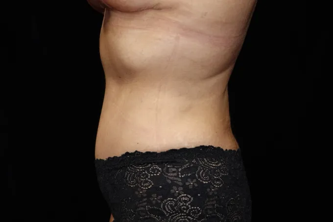 before-after-tummy-tuck-abdominoplasty-2424f