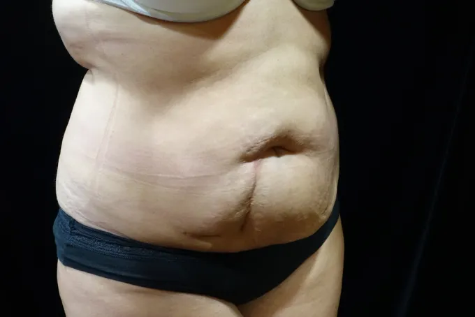 before-after-tummy-tuck-abdominoplasty-1212a