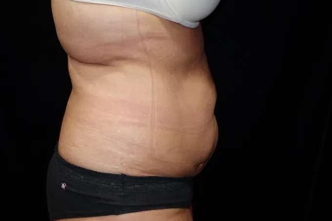 before-after-tummy-tuck-abdominoplasty-1212a