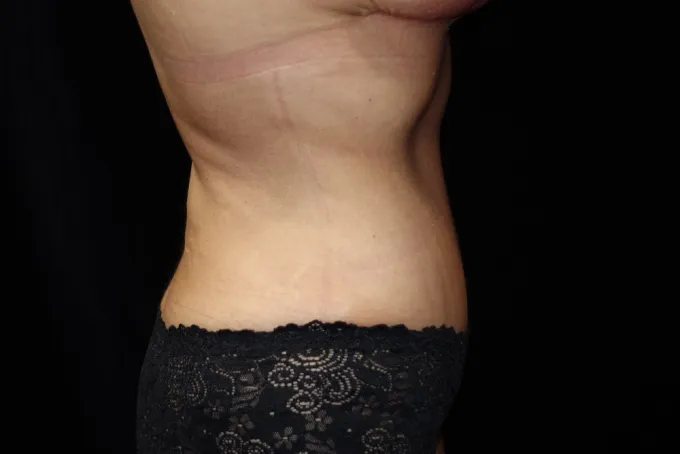 before-after-tummy-tuck-abdominoplasty-2424j