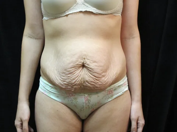 before-after-tummy-tuck-abdominoplasty-1212a