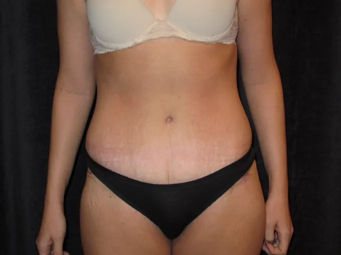 before-after-tummy-tuck-abdominoplasty-2626b