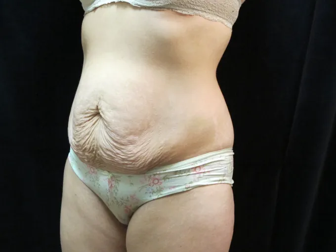 before-after-tummy-tuck-abdominoplasty-1212a