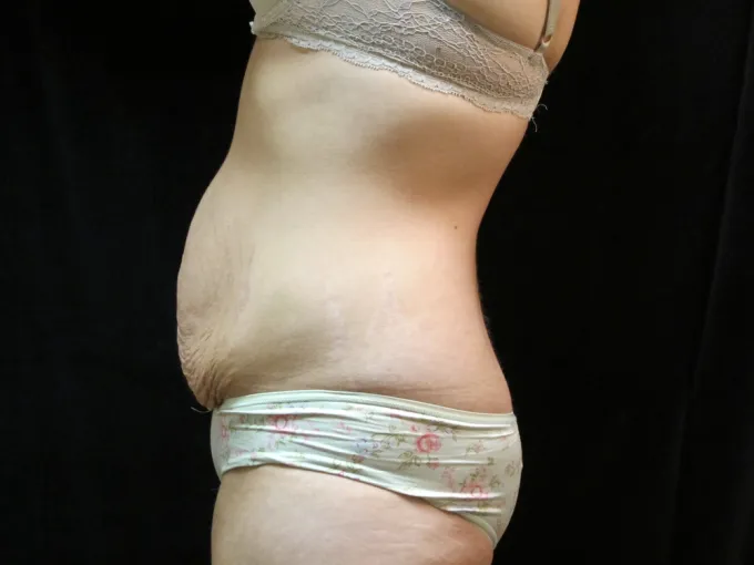 before-after-tummy-tuck-abdominoplasty-1212a