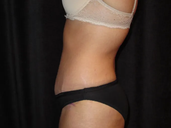 before-after-tummy-tuck-abdominoplasty-2626f