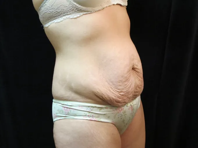 before-after-tummy-tuck-abdominoplasty-1212a