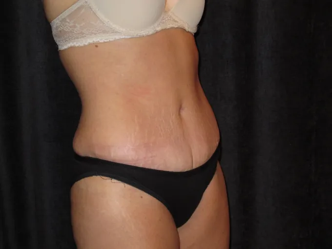 before-after-tummy-tuck-abdominoplasty-2626h