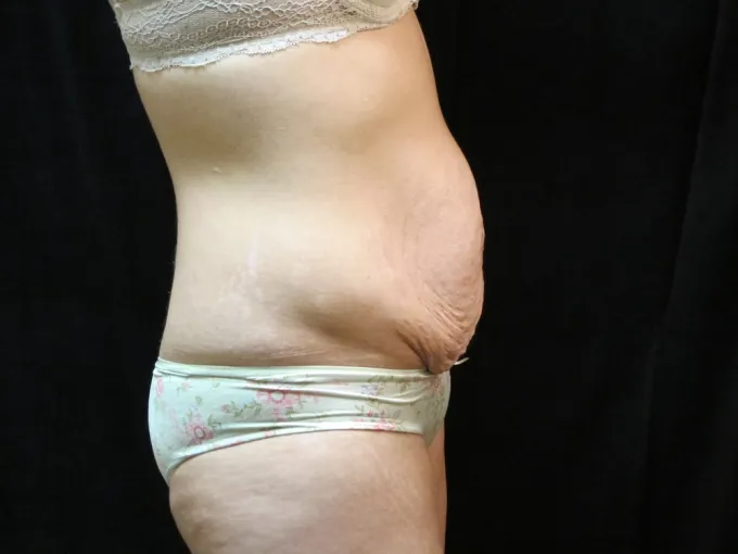 before-after-tummy-tuck-abdominoplasty-1212a