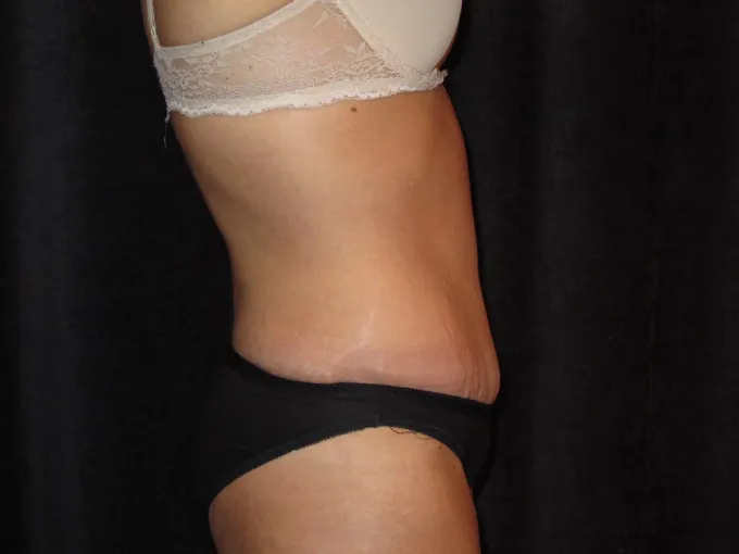 before-after-tummy-tuck-abdominoplasty-2626j