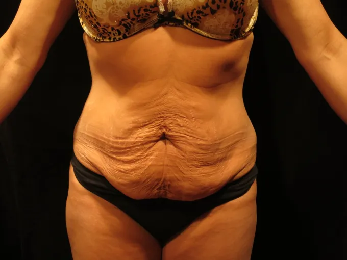 before-after-tummy-tuck-abdominoplasty-1212a