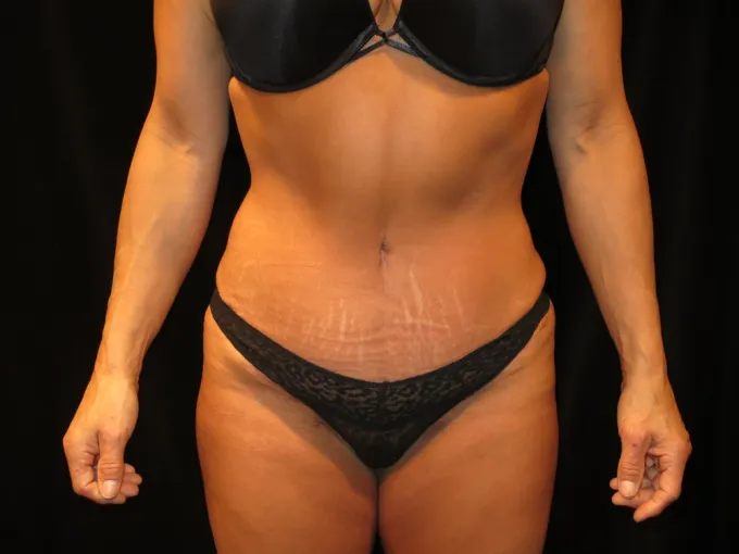 before-after-tummy-tuck-abdominoplasty-2727b