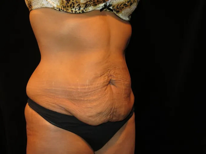 before-after-tummy-tuck-abdominoplasty-1212a