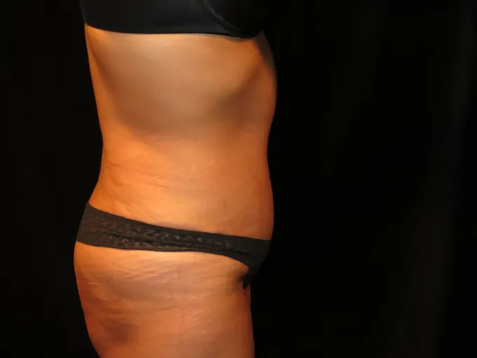 before-after-tummy-tuck-abdominoplasty-2727f