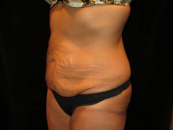 before-after-tummy-tuck-abdominoplasty-1212a
