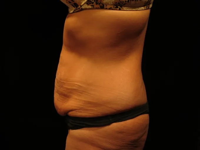 before-after-tummy-tuck-abdominoplasty-1212a