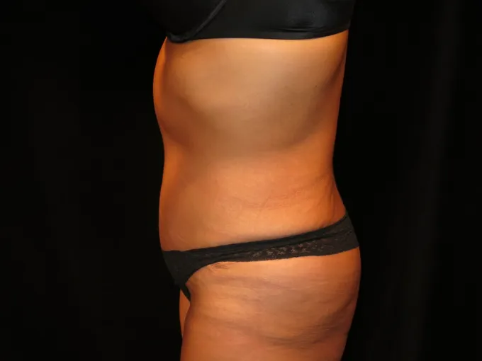 before-after-tummy-tuck-abdominoplasty-2727j